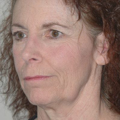Ponytail Facelift before and after, case 41, view 3 (before)
