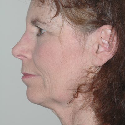 Ponytail Facelift before and after, case 41, view 4 (before)