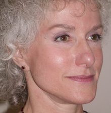Ponytail Facelift before and after, case 42 (after)