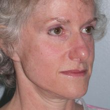 Ponytail Facelift before and after, case 42 (before)