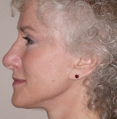 Ponytail Facelift before and after, case 42, view 4 (after)