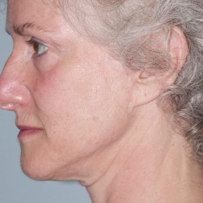 Ponytail Facelift before and after, case 42, view 4 (before)