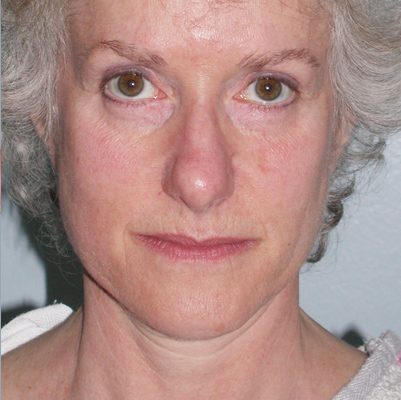 Ponytail Facelift before and after, case 42, view 5 (before)