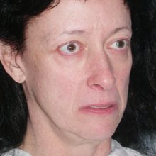 Ponytail Facelift before and after, case 43 (before)