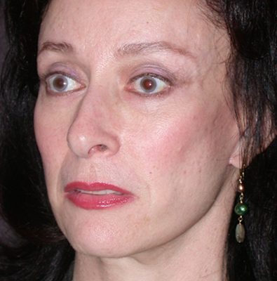 Ponytail Facelift before and after, case 43, view 3 (after)