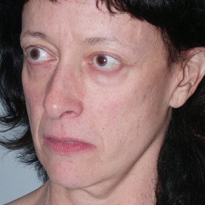 Ponytail Facelift before and after, case 43, view 3 (before)