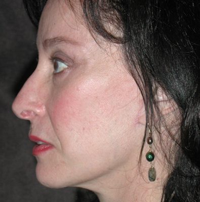 Ponytail Facelift before and after, case 43, view 4 (after)