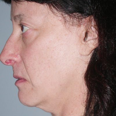 Ponytail Facelift before and after, case 43, view 4 (before)