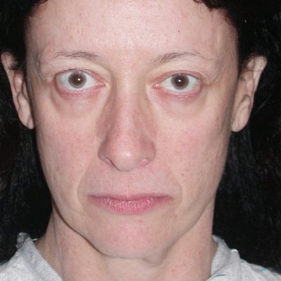 Ponytail Facelift before and after, case 43, view 5 (before)