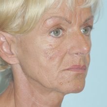 Ponytail Facelift before and after, case 44 (before)