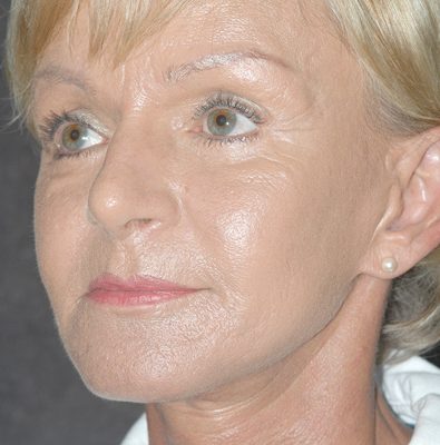 Ponytail Facelift before and after, case 44, view 3 (after)