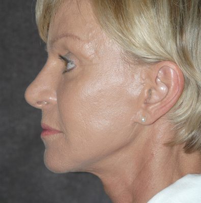 Ponytail Facelift before and after, case 44, view 4 (after)