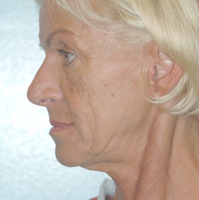 Ponytail Facelift before and after, case 44, view 4 (before)
