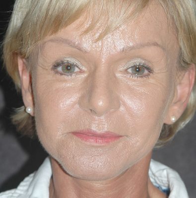 Ponytail Facelift before and after, case 44, view 5 (after)