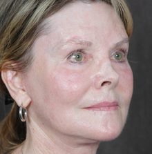 Ponytail Facelift before and after, case 45 (after)