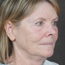 Ponytail Facelift before and after, case 45 (before)