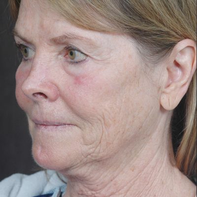 Ponytail Facelift before and after, case 45, view 3 (before)
