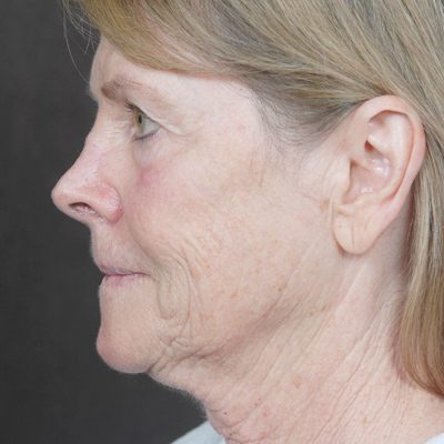Ponytail Facelift before and after, case 45, view 4 (before)