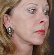 Ponytail Facelift before and after, case 46 (after)