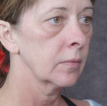 Ponytail Facelift before and after, case 46 (before)