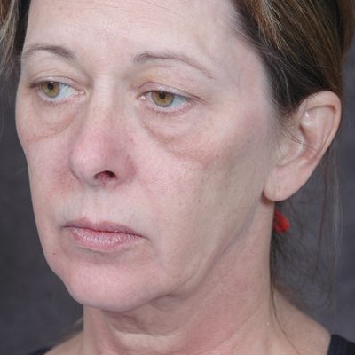 Ponytail Facelift before and after, case 46, view 3 (before)