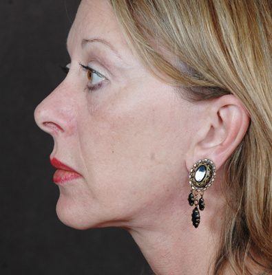 Ponytail Facelift before and after, case 46, view 4 (after)
