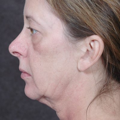 Ponytail Facelift before and after, case 46, view 4 (before)