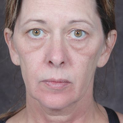 Ponytail Facelift before and after, case 46, view 5 (before)
