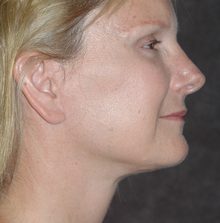 Ponytail Facelift before and after, case 47 (after)
