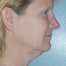 Ponytail Facelift before and after, case 47 (before)
