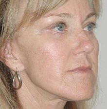 Ponytail Facelift before and after, case 48 (after)