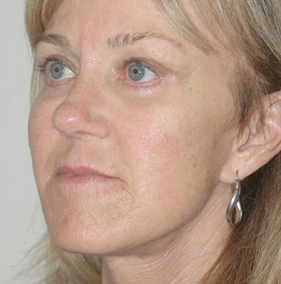Ponytail Facelift before and after, case 48, view 3 (after)