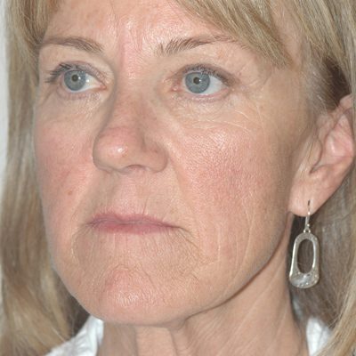 Ponytail Facelift before and after, case 48, view 3 (before)
