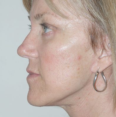 Ponytail Facelift before and after, case 48, view 4 (after)