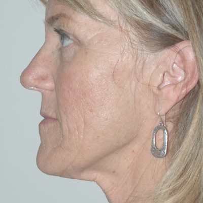 Ponytail Facelift before and after, case 48, view 4 (before)