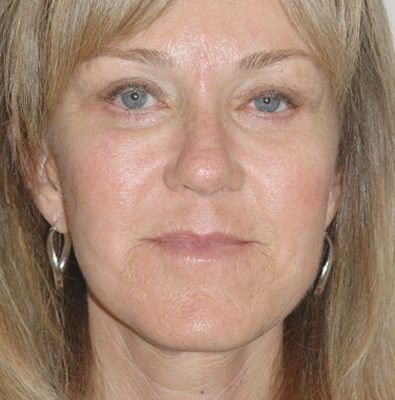 Ponytail Facelift before and after, case 48, view 5 (after)