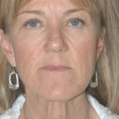 Ponytail Facelift before and after, case 48, view 5 (before)