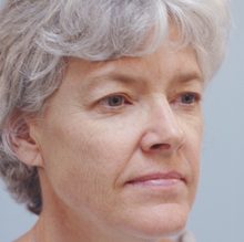 Ponytail Facelift before and after, case 49 (before)