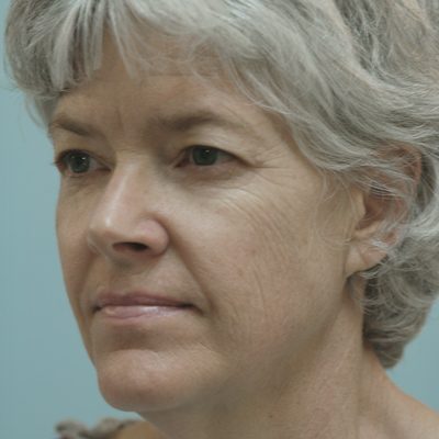 Ponytail Facelift before and after, case 49, view 3 (before)