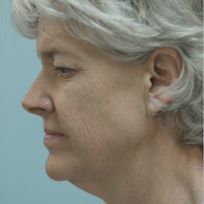 Ponytail Facelift before and after, case 49, view 4 (before)