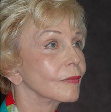 Ponytail Facelift before and after, case 50 (after)