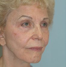 Ponytail Facelift before and after, case 50 (before)