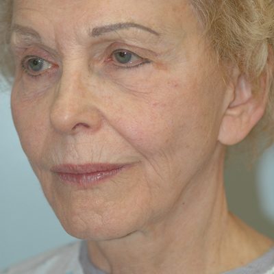 Ponytail Facelift before and after, case 50, view 3 (before)