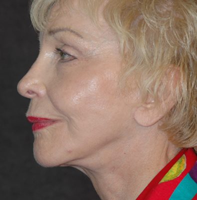 Ponytail Facelift before and after, case 50, view 4 (after)