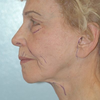 Ponytail Facelift before and after, case 50, view 4 (before)