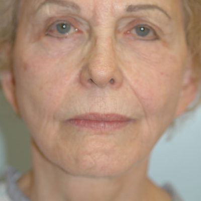 Ponytail Facelift before and after, case 50, view 5 (before)