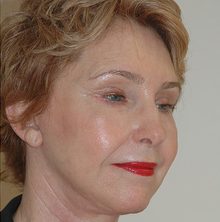 Ponytail Facelift before and after, case 51 (after)