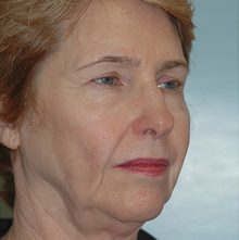 Ponytail Facelift before and after, case 51 (before)