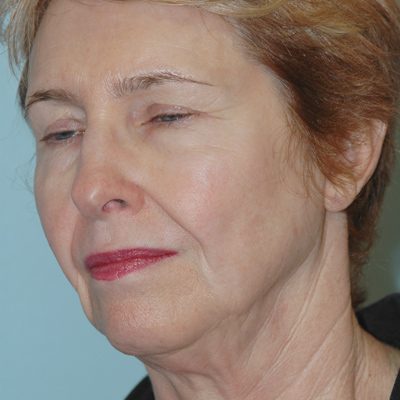 Ponytail Facelift before and after, case 51, view 3 (before)
