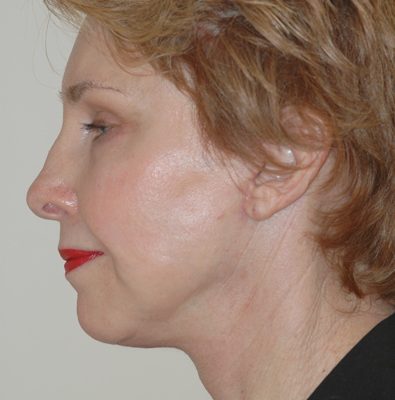 Ponytail Facelift before and after, case 51, view 4 (after)
